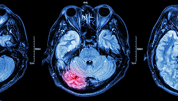 Brain Contusion